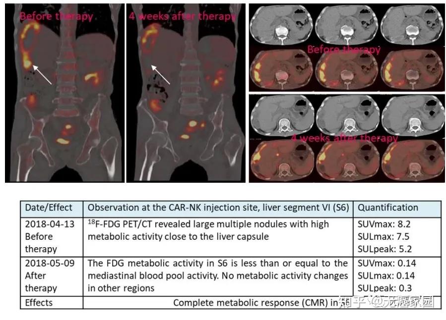 CAR-T疗法显著提升晚期胃癌治疗效果