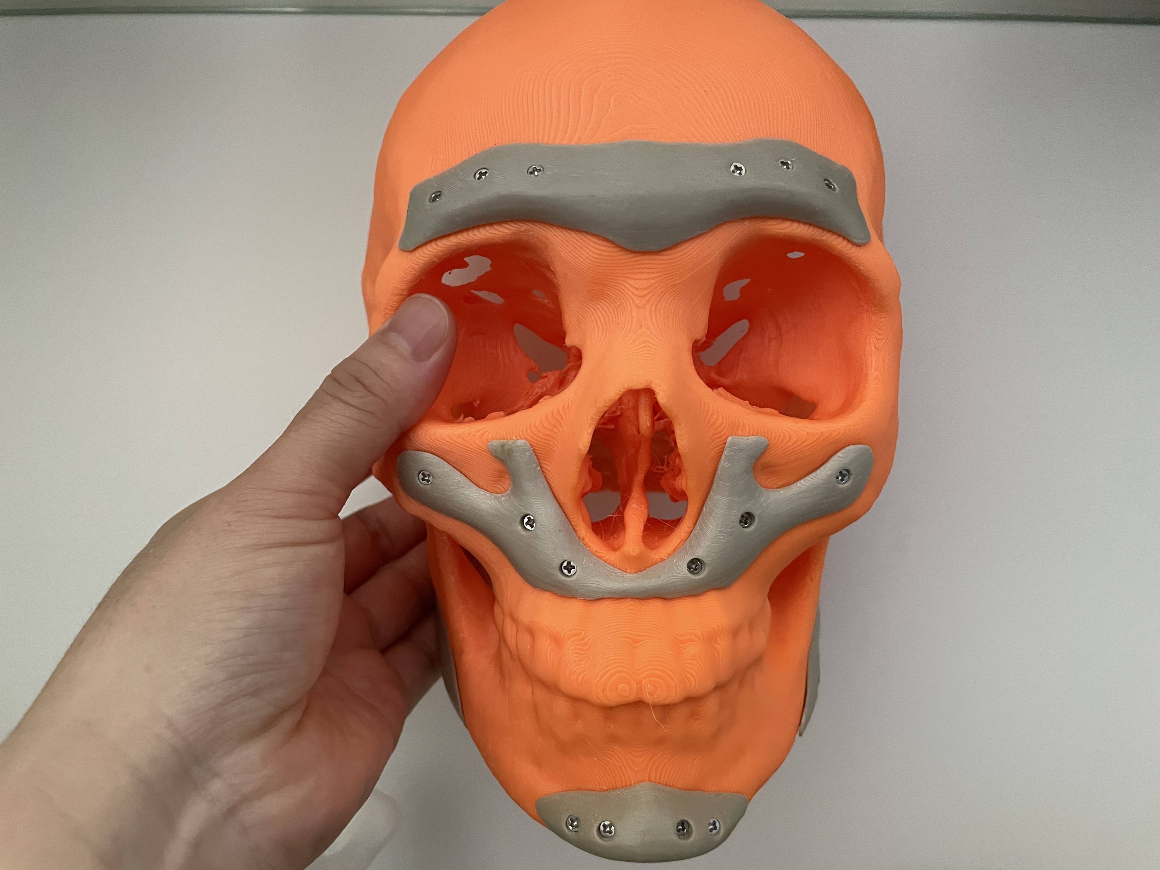 大博医疗获得发明专利授权：“一种协同效用的3D打印金属植入物及其制备方法”