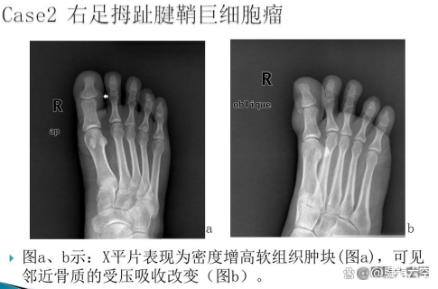 阿里健康拿下贝捷迈®全国首发 系中国首个腱鞘巨细胞瘤（TGCT）口服新药