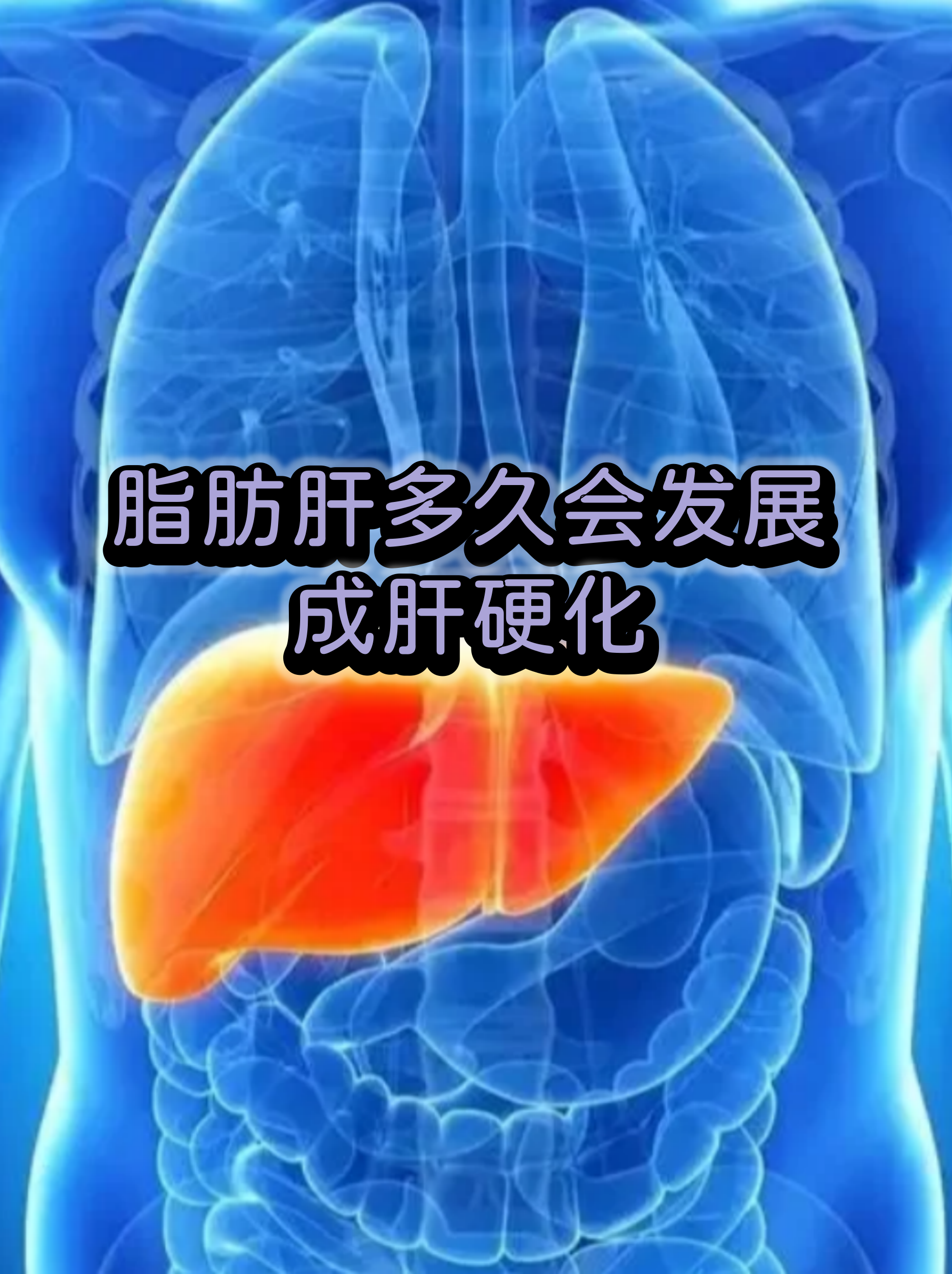 加速代谢相关脂肪肝患者肝纤维化的“隐形杀手”被发现